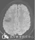胚胎发育不良性神经上皮瘤 <wbr>(Dysembryoplastic<wbr>Neuroepithelial<wbr>tumor,DNET)