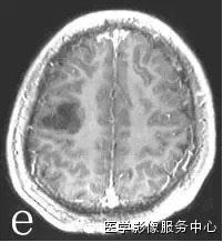 胚胎发育不良性神经上皮瘤 <wbr>(Dysembryoplastic<wbr>Neuroepithelial<wbr>tumor,DNET)