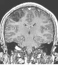 胚胎发育不良性神经上皮瘤 <wbr>(Dysembryoplastic<wbr>Neuroepithelial<wbr>tumor,DNET)