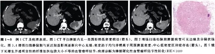【病例】脾硬化性血管瘤样结节性转化的影像学表现2例