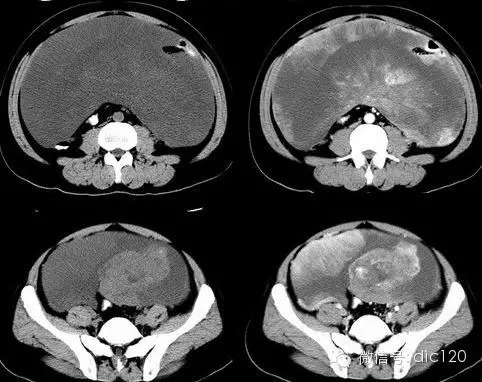 【典型病例】腹腔巨大恶性间质瘤CT病例一例 【典型病例】腹腔巨大恶性间质瘤CT病例一例