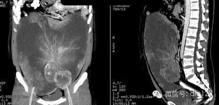 【典型病例】腹腔巨大恶性间质瘤CT病例一例 【典型病例】腹腔巨大恶性间质瘤CT病例一例