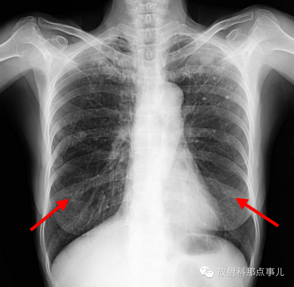 掌握看X线胸片的六要点,胸片轻松看 掌握看X线胸片的六要点,胸片轻松看