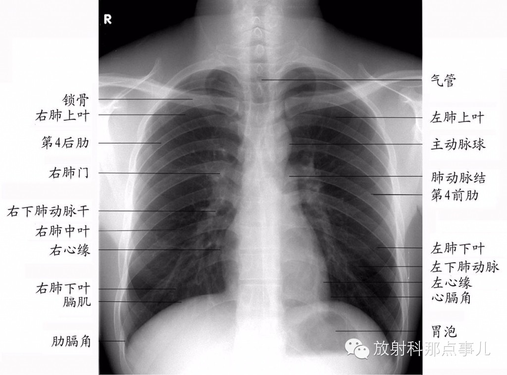 掌握看X线胸片的六要点,胸片轻松看 掌握看X线胸片的六要点,胸片轻松看