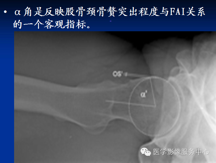 髋关节撞击综合征的影像诊断