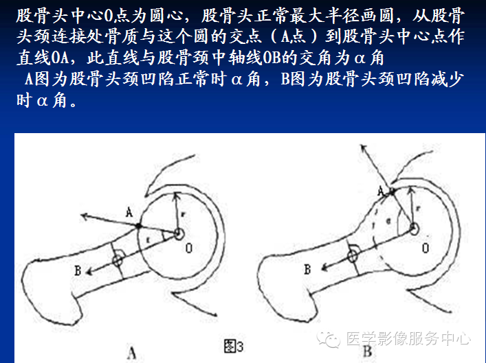 髋关节撞击综合征的影像诊断