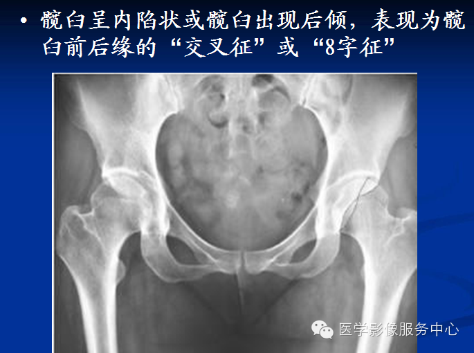 髋关节撞击综合征的影像诊断