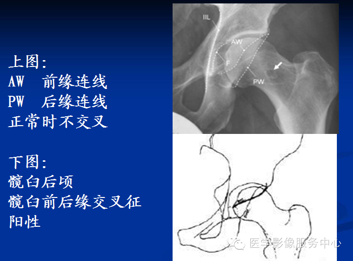 髋关节撞击综合征的影像诊断