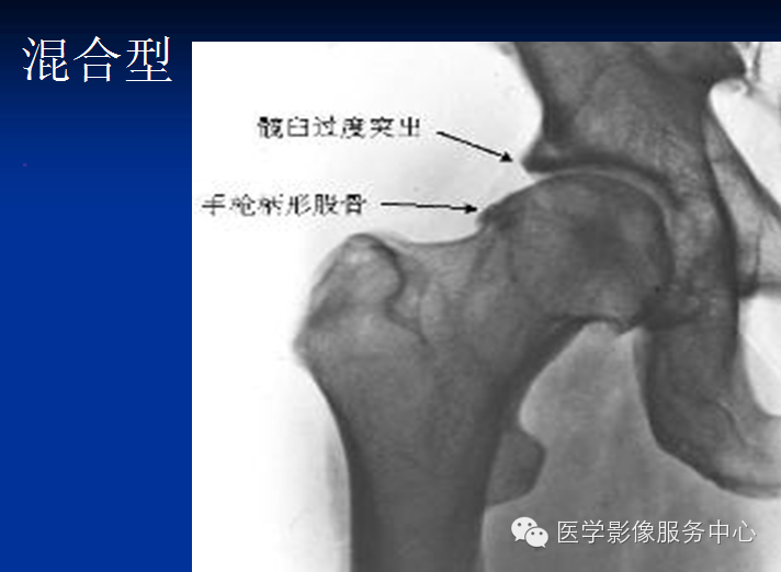 髋关节撞击综合征的影像诊断