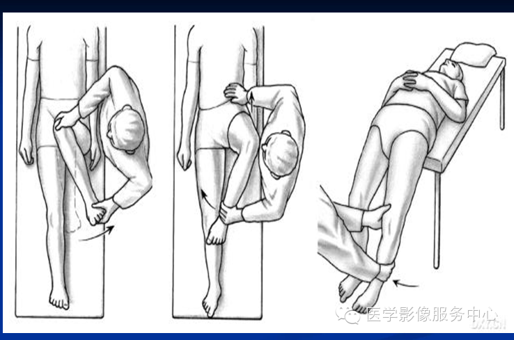 髋关节撞击综合征的影像诊断