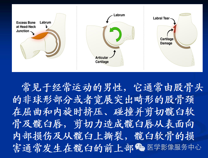 髋关节撞击综合征的影像诊断
