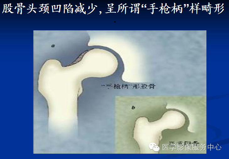 髋关节撞击综合征的影像诊断