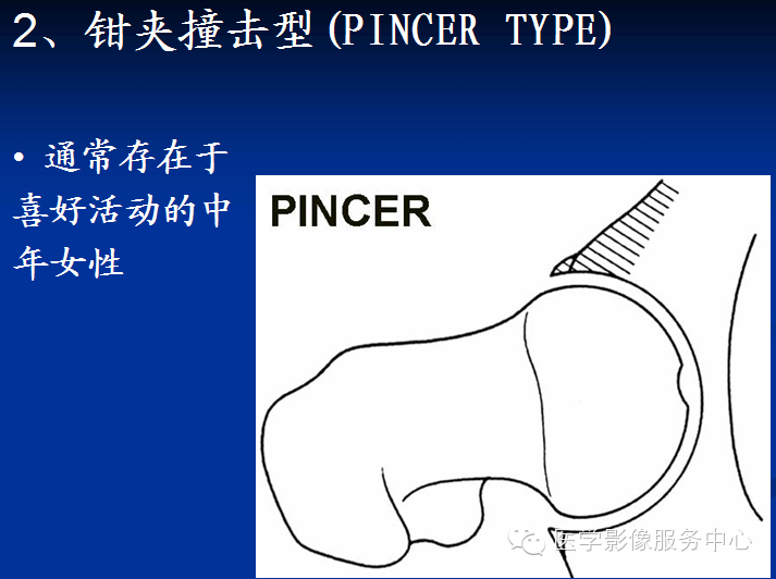 髋关节撞击综合征的影像诊断