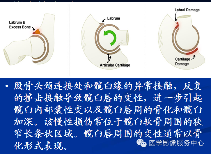 髋关节撞击综合征的影像诊断