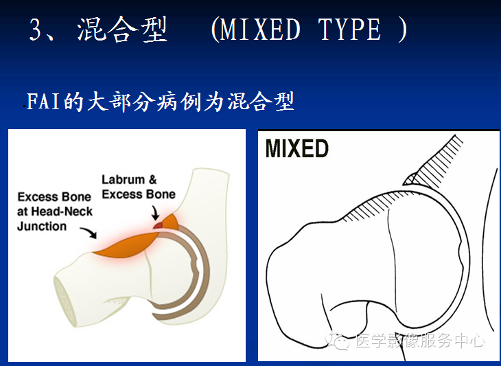 髋关节撞击综合征的影像诊断