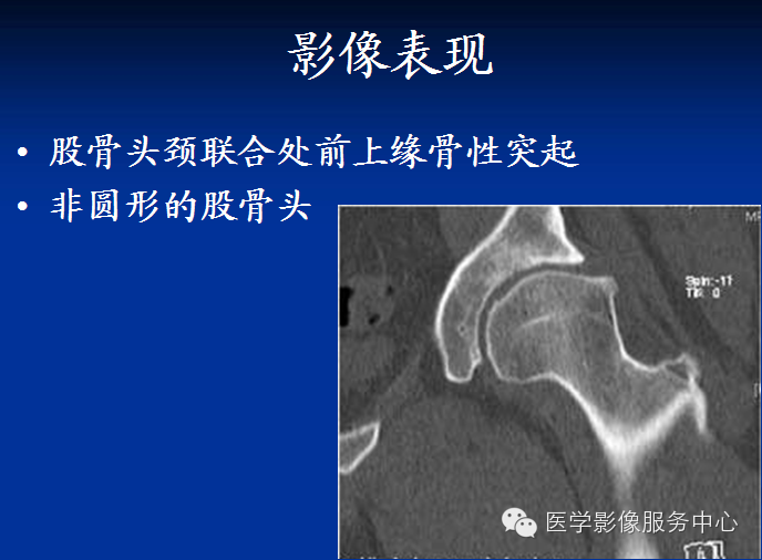 髋关节撞击综合征的影像诊断