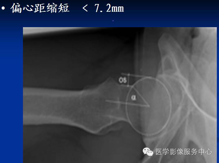 髋关节撞击综合征的影像诊断