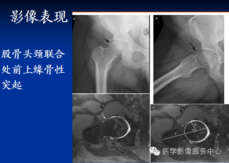髋关节撞击综合征的影像诊断