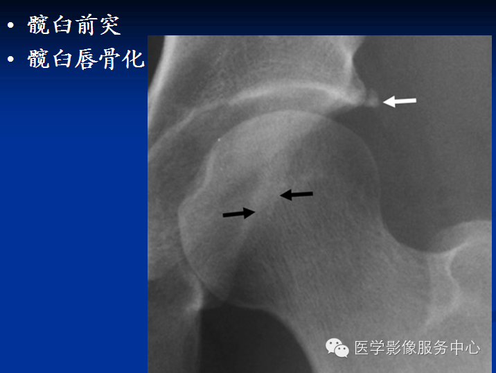 髋关节撞击综合征的影像诊断