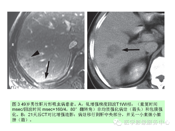 肝包膜及包膜下病变的CT及MRI表现