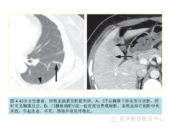 肝包膜及包膜下病变的CT及MRI表现