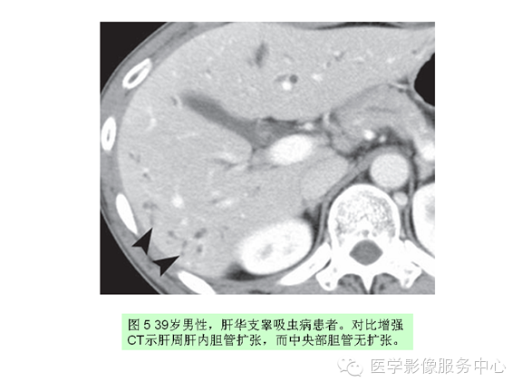 肝包膜及包膜下病变的CT及MRI表现