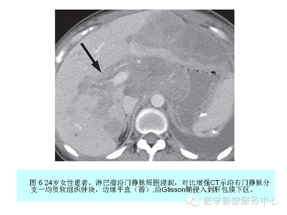 肝包膜及包膜下病变的CT及MRI表现