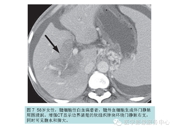 肝包膜及包膜下病变的CT及MRI表现