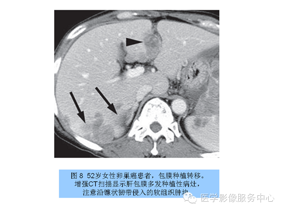 肝包膜及包膜下病变的CT及MRI表现