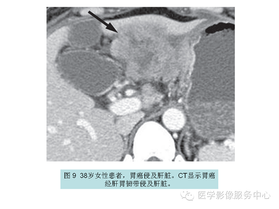 肝包膜及包膜下病变的CT及MRI表现