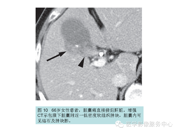 肝包膜及包膜下病变的CT及MRI表现