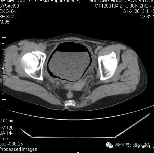 【病例】气肿性膀胱炎一例