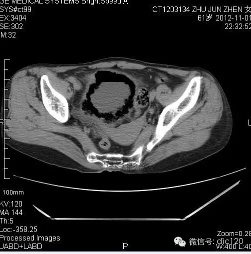 【病例】气肿性膀胱炎一例 【病例】气肿性膀胱炎一例