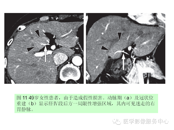肝包膜及包膜下病变的CT及MRI表现