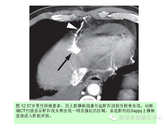 肝包膜及包膜下病变的CT及MRI表现