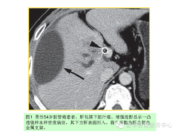肝包膜及包膜下病变的CT及MRI表现
