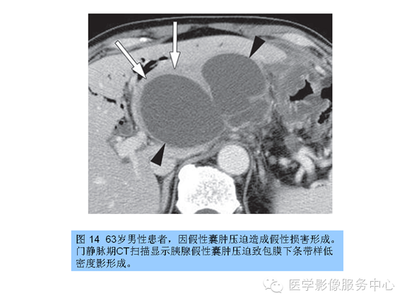 肝包膜及包膜下病变的CT及MRI表现