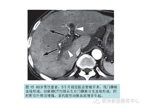 肝包膜及包膜下病变的CT及MRI表现