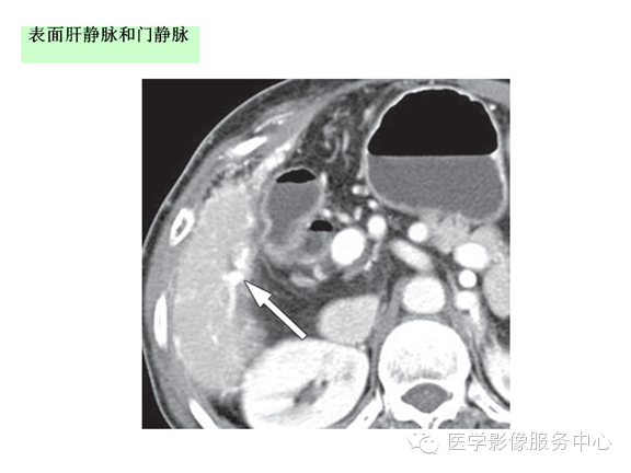 肝包膜及包膜下病变的CT及MRI表现