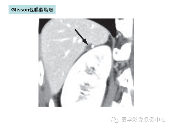 肝包膜及包膜下病变的CT及MRI表现