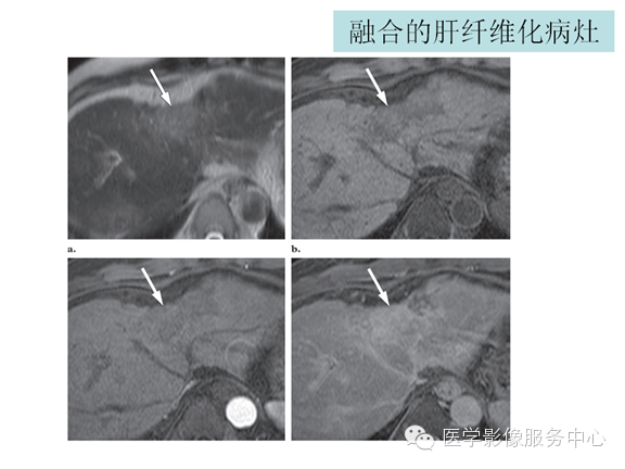肝包膜及包膜下病变的CT及MRI表现