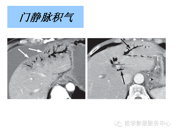 肝包膜及包膜下病变的CT及MRI表现