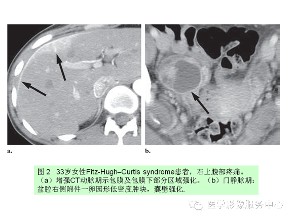 肝包膜及包膜下病变的CT及MRI表现