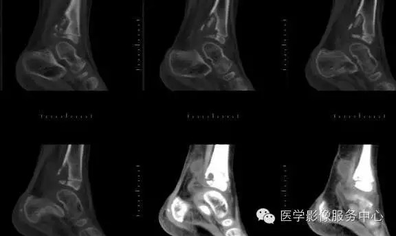 【病例学习】长骨结核的影像诊断分析