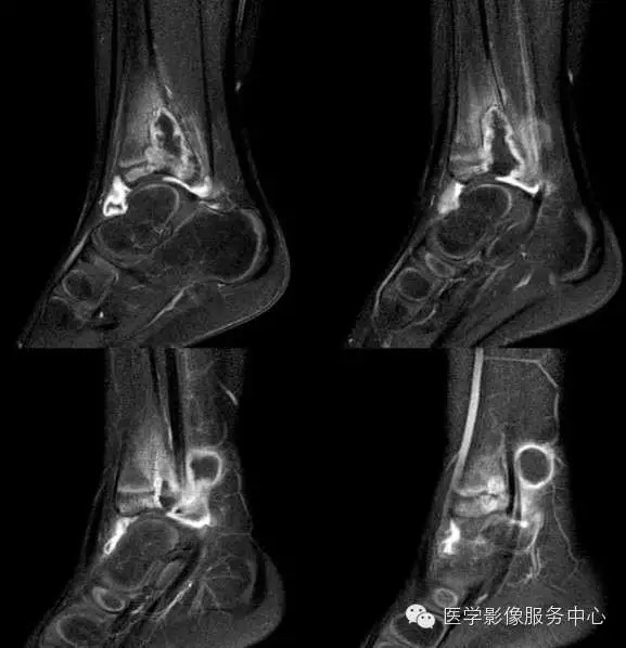 【病例学习】长骨结核的影像诊断分析