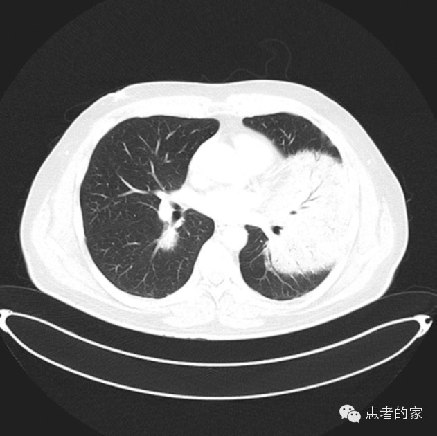 【病例】原发性肺粘膜相关淋巴组织淋巴瘤一例