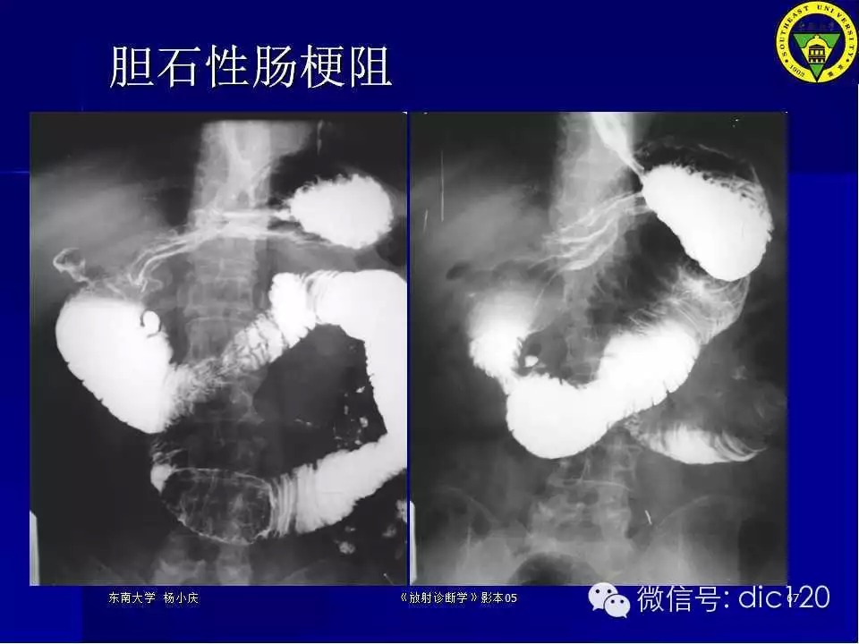 急腹症的影像学诊断