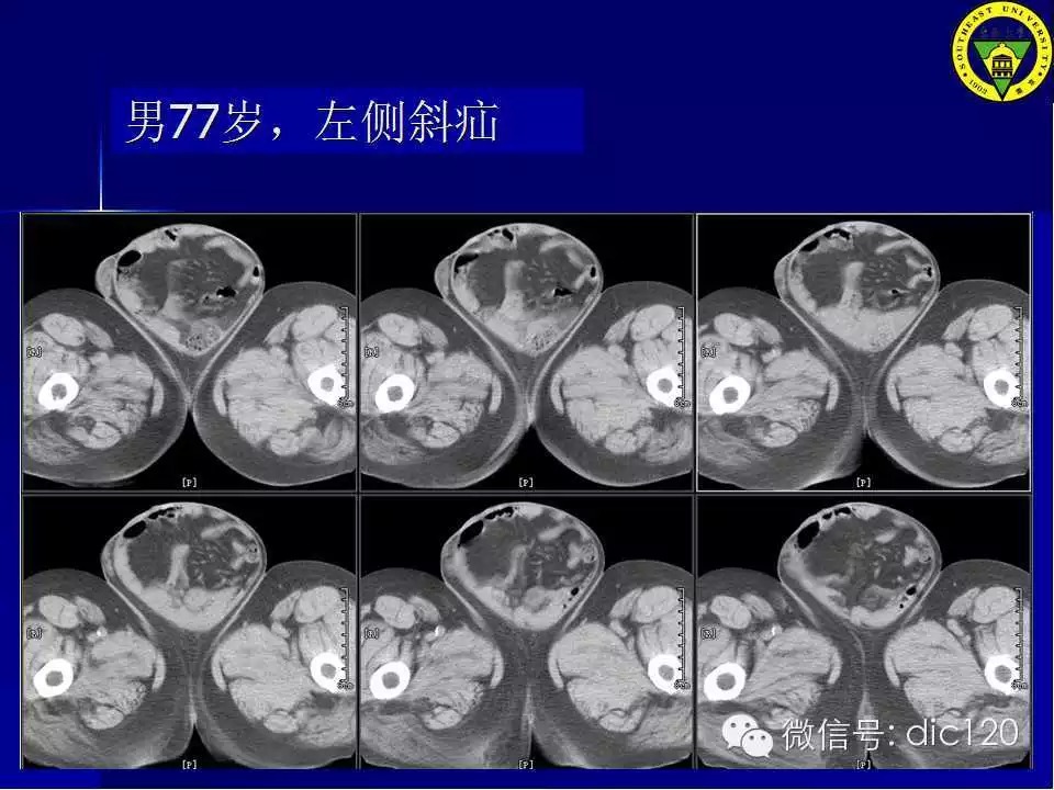 急腹症的影像学诊断