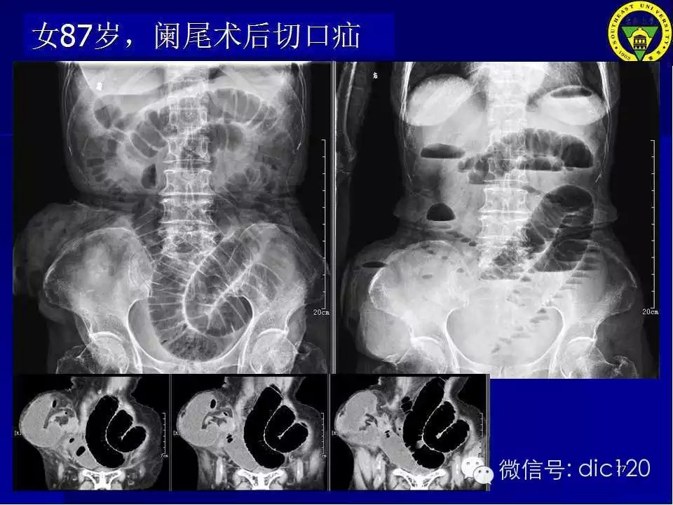 急腹症的影像学诊断