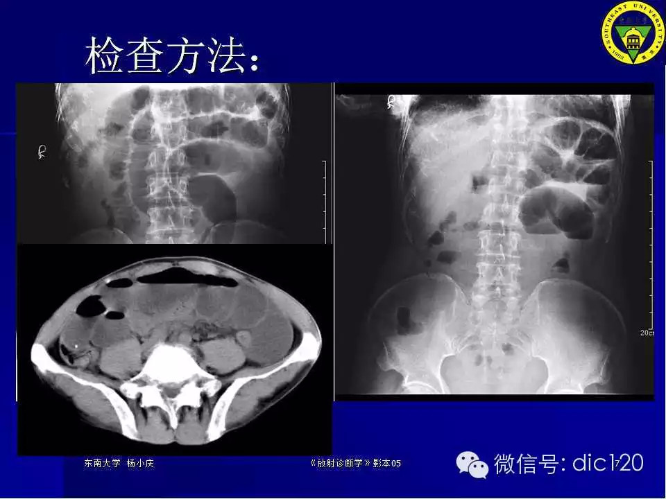 急腹症的影像学诊断